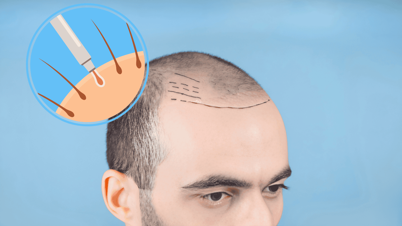 The Emotional Aspects of a Hair Transplant